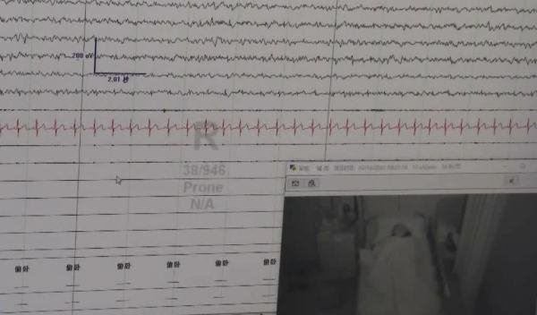 女孩基因突变最快48秒睡着 大笑就浑身无力想睡觉引网友羡慕：医生揭秘